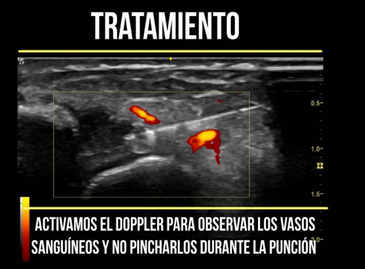 electrolisis-ligamento-peroneo-astragalino-anterior